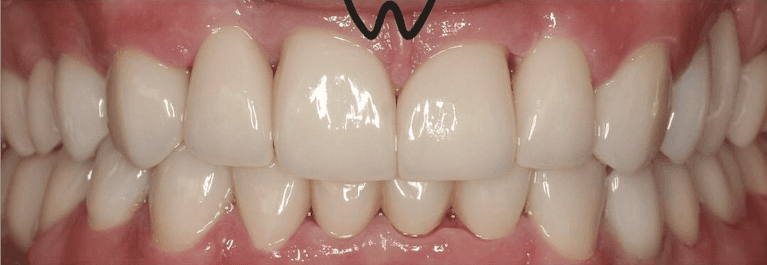 Smile-Transformation-After-Image