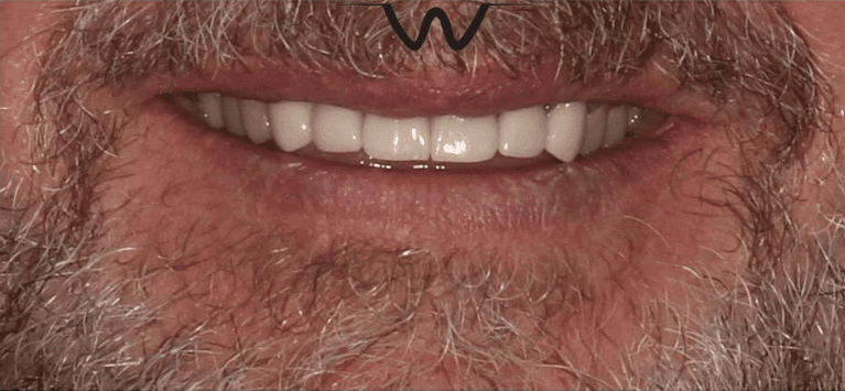 Crowns-After-Image