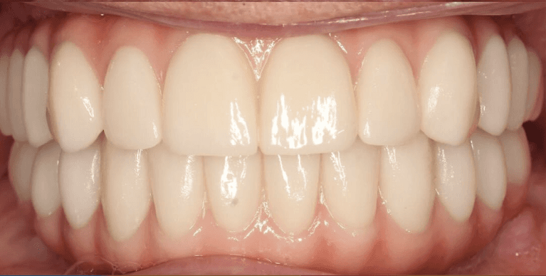 Full-Mouth-Reconstruction-After-Image