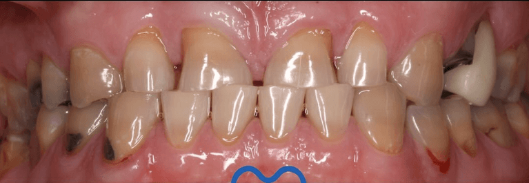 Smile-Transformation-Before-Image