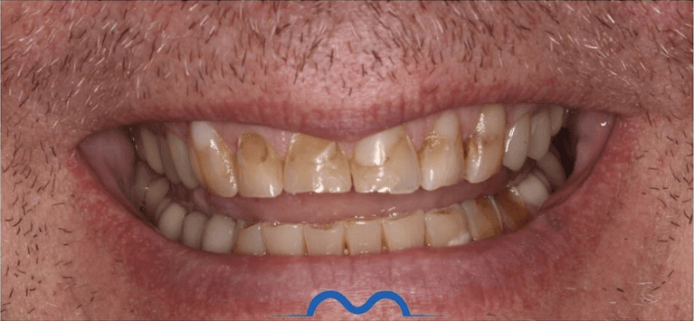 Crowns-Before-Image