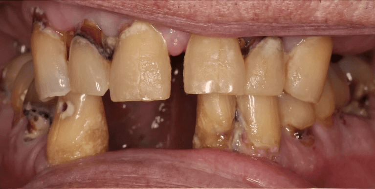 Full-Mouth-Reconstruction-Before-Image