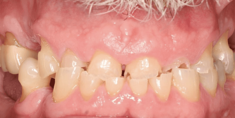 Implants-Before-Image