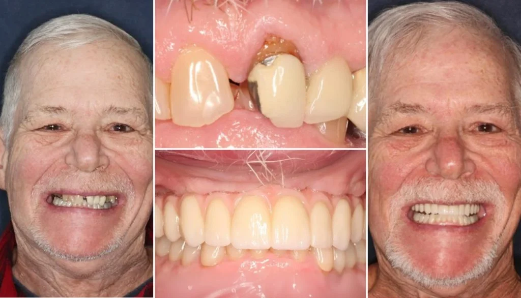 Before and after: older man’s broken front teeth restored