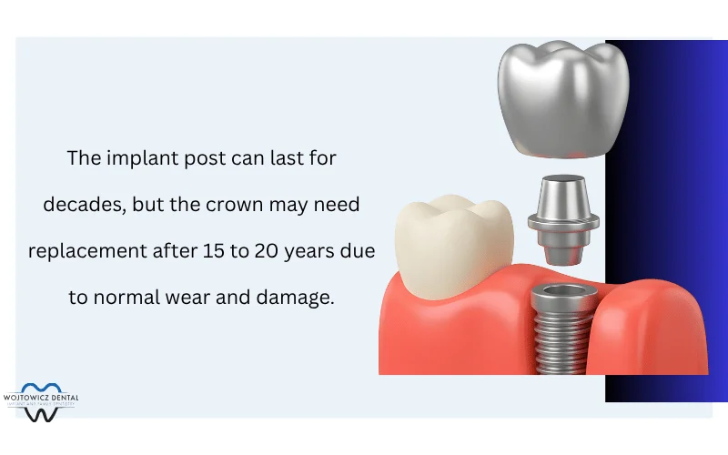 Role of the Abutment and Dental Crown