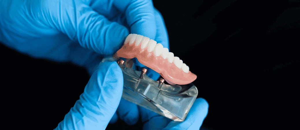 Already Wearing Dentures? How Implant-Supported Dentures Stabilize Them Without Full-Arch Surgery