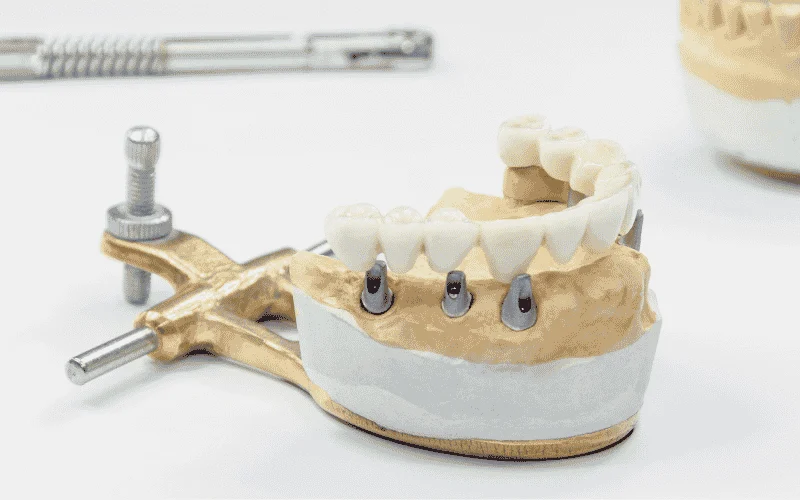 how long do dental implants last